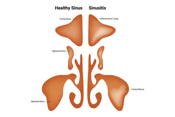 Download Healthy Sinus Sinusitis Science Design - Design Collection